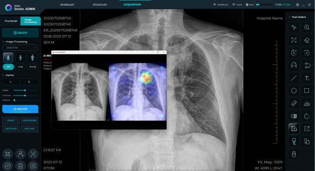 광주 의료기기 전문 제조기업 ㈜오톰이 개발한 AI(인공지능) 진단 소프트웨어 ‘O-View AI’로 환자의 흉부 질환을 진단하는 화면. 오톰 제공